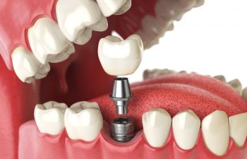 Dental Implant