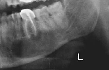 Oral Pathology xray