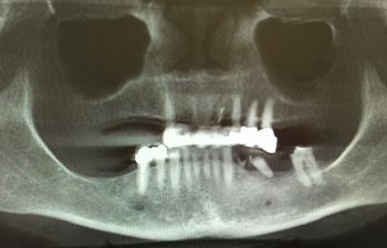 Extraction of failing teeth with 7 implants Before