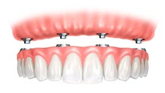 dental implant