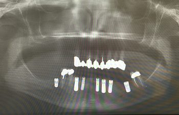 Extraction of failing teeth with 7 implants After