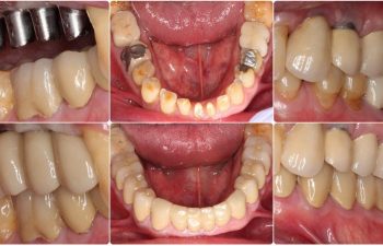 Sinus Bone graft with 4 Implants After