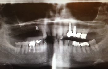 Sinus Bone graft with 4 Implants Before