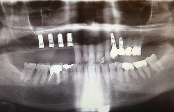 Sinus Bone graft with 4 Implants After