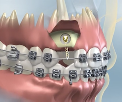 Elevation of the gum with a bone window created to identify tooth. A special bracket has been placed on tooth.