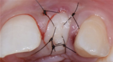  gum after the procedure