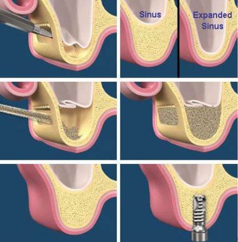 Diagram of the bone graft procedure