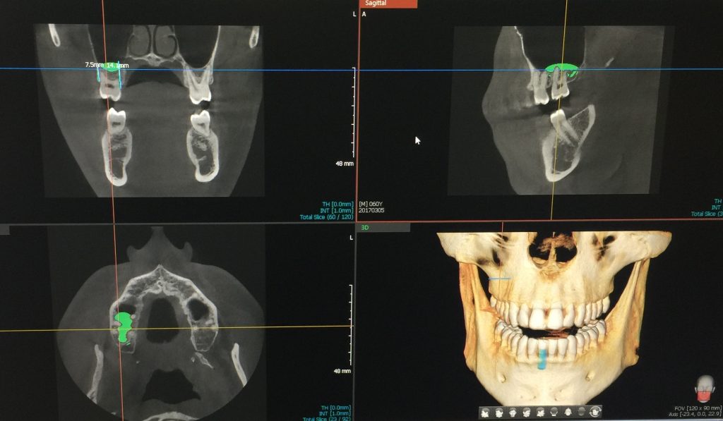 3-D CT Scans