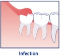 gum infection iconography