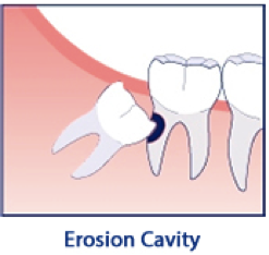 erosion cavity iconography