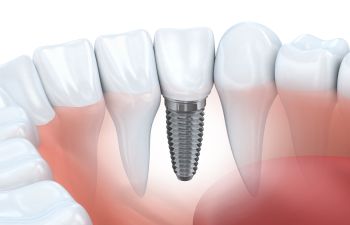 Dental Implants Torrance CA