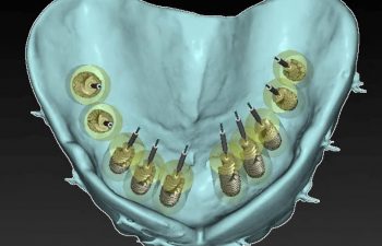 3D Dental Implant Imaging at Torrance Oral Surgery and Dental Implant Center