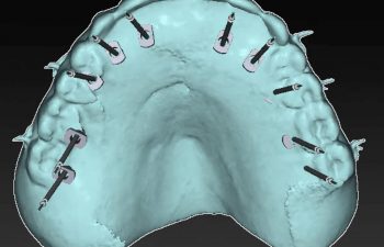 Digitally Planned Dental Implants at Torrance Oral Surgery and Dental Implant Center