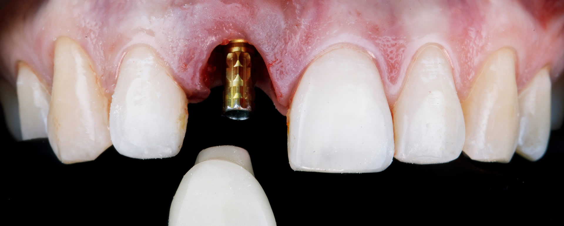 Dental implant