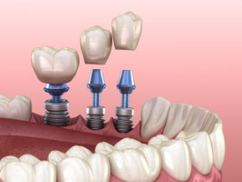 3 tooth crowns placement over 3 implants - concept. 3D illustration of human teeth and dentures