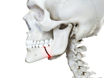 3d rendered medically accurate illustration of a broken jaw