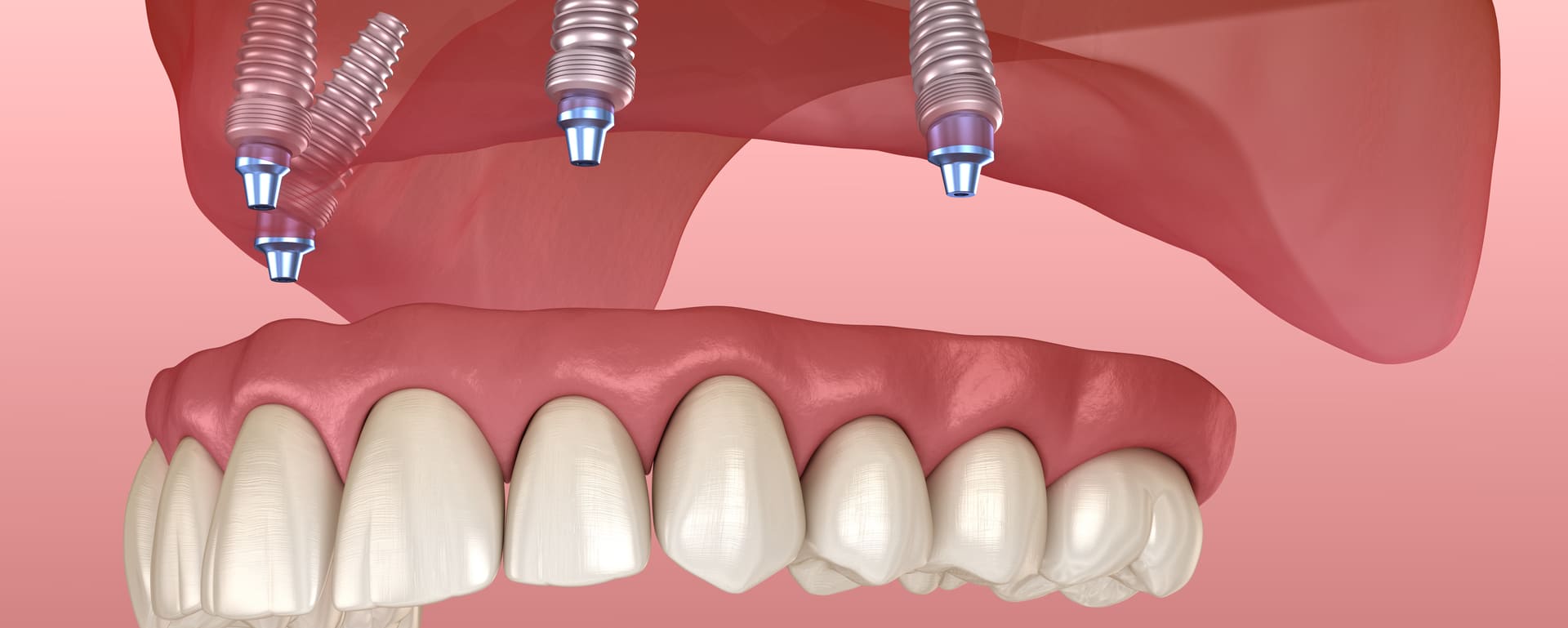 all on 4 dental procedure