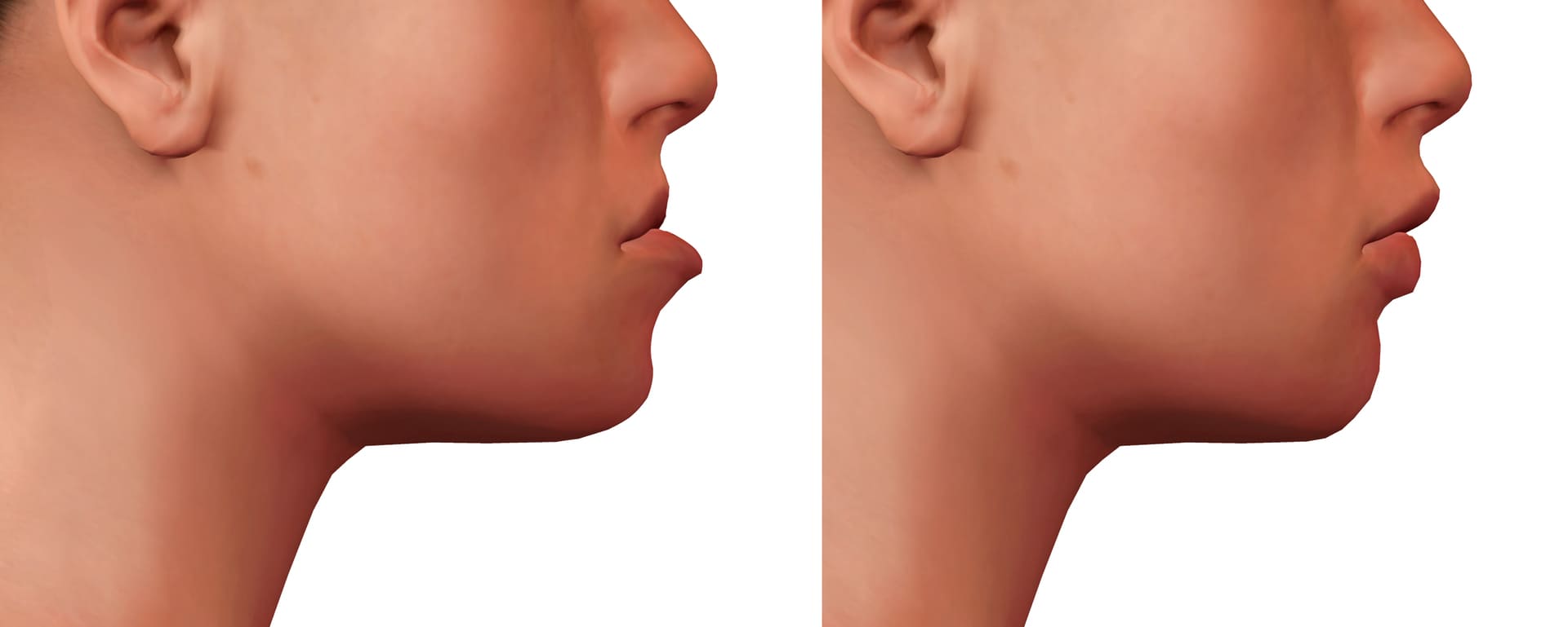 Jaw Surgery